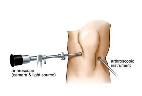 Knee Arthroscopy