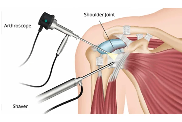 Shoulder Arthroscopy