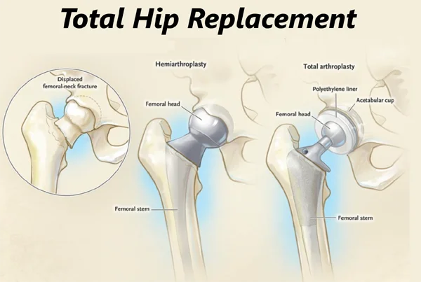 Total Hip Replacement