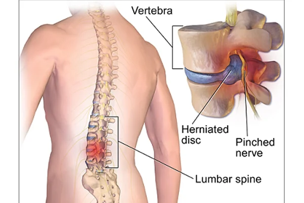 Open Spine Surgery